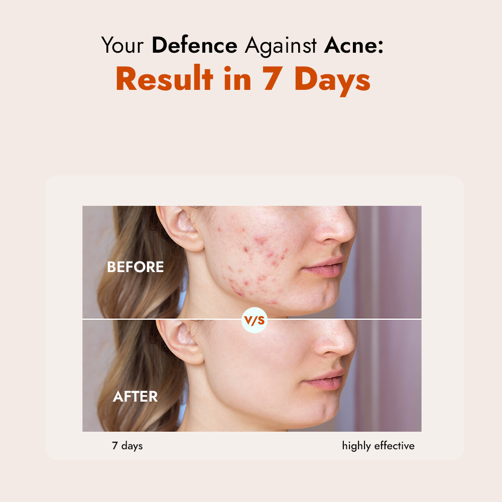 Acne Care Face Wash with 2% Salicylic Acid